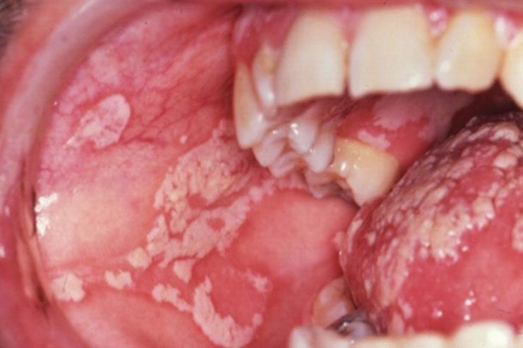 Oral Thrush: Causes, Symptoms, Treatment
