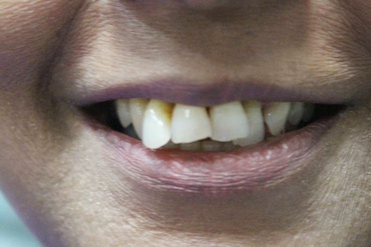 Home Remedies for Shaking Teeth