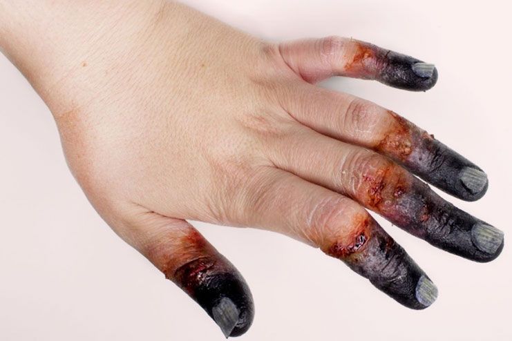 How to Cure Frostbite With Effective Treatment