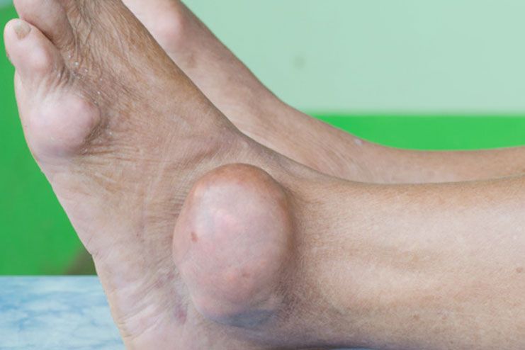 What is Gout?: Causes, Symptoms and Treatment