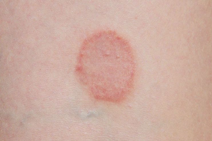 Ringworm on Tattoo: Is it Contagious? - wide 2