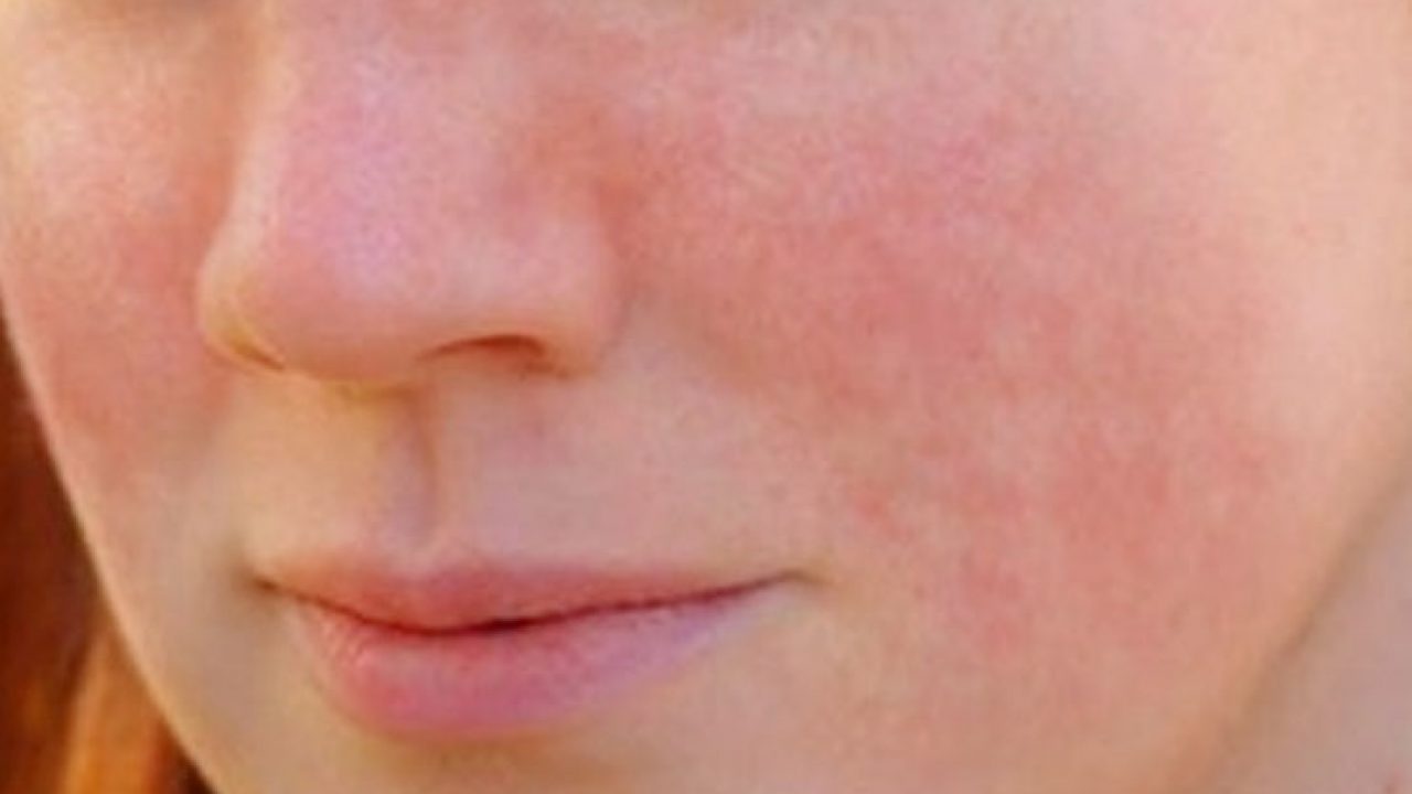 Types And Causes For Lupus Rash
