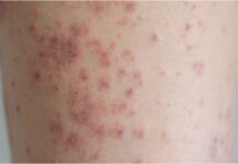 Heat Rash: Causes, Symptoms, Treatment and Prevention Heat Rash Causes Symptoms