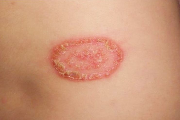 How To Get Rid of Ringworm? 25 Effective Home Remedies To Look Into