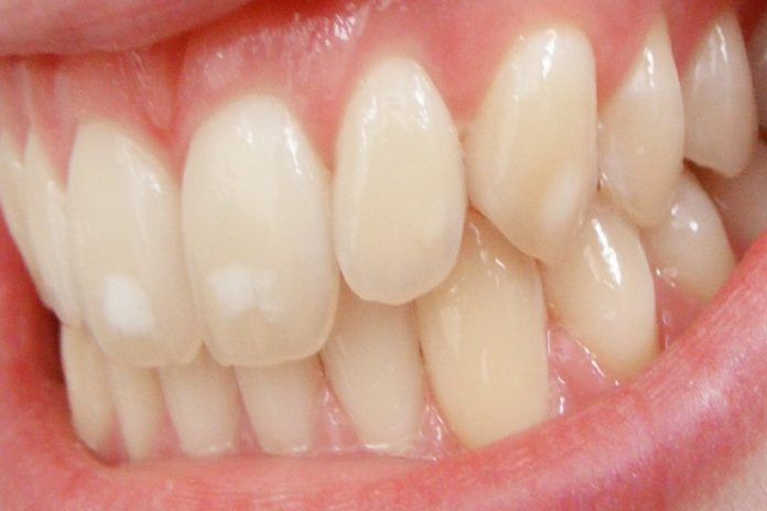 removal of white patches from teeth