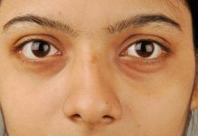 14 Natural Home Remedies for Treating Undereye Dark Circles Dark circles under eyes