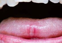 19 Top Home Remedies for Tongue Sores and Blisters Home Remedies for Tongue Sores