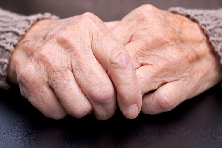 Scientists Have Identified the Causative Gene Behind Rheumatoid Arthritis – Study Shows Evidence