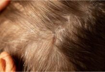 16 Natural Remedies To Say Goodbye To Scabs on Scalp (Without any Pain) 16 Natural Remedies To Say Goodbye