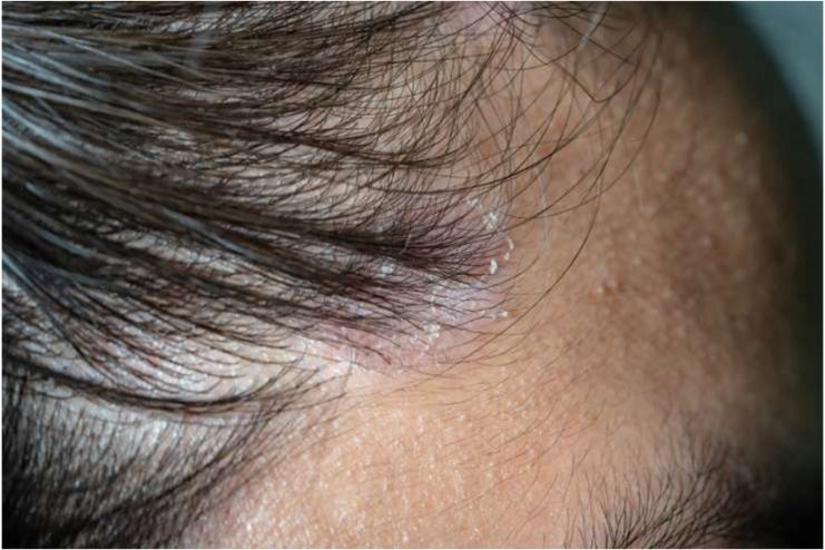 Causes Scabs on the Scalp