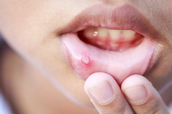 Mouth ulcers