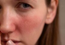 12 Easy And Effective Natural Remedies To Treat Redness On Face 12-Easy-And-Effective-Natural-Remedies