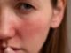 12 Easy And Effective Natural Remedies To Treat Redness On Face 12-Easy-And-Effective-Natural-Remedies