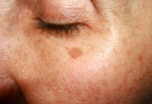 15 Natural Remedies For Age Spots That You Can Swear By Age Spots on Face