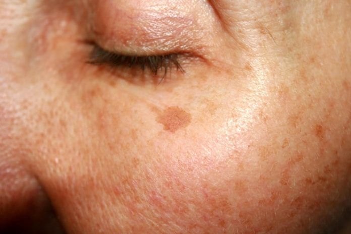 Age Spots on Face
