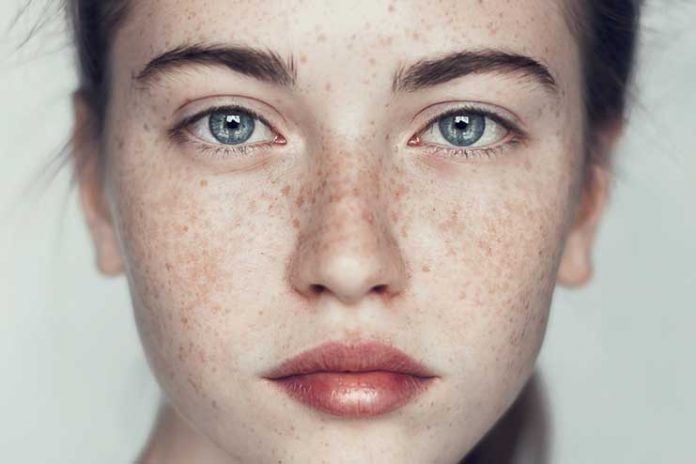 freckles treatment