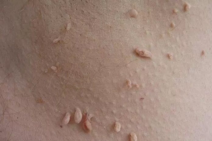 How to remove skin tags