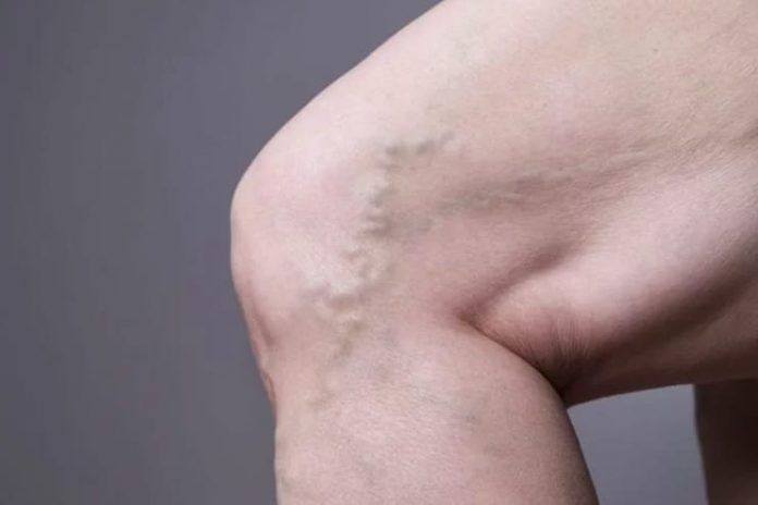 Varicose Veins