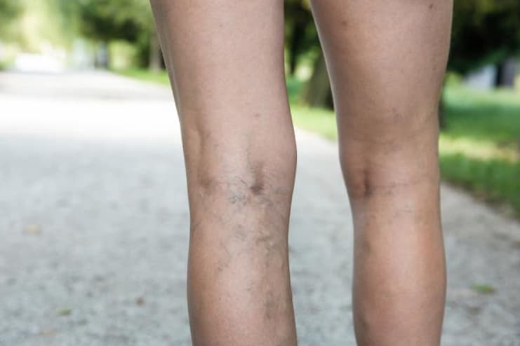 causes of Varicose Veins