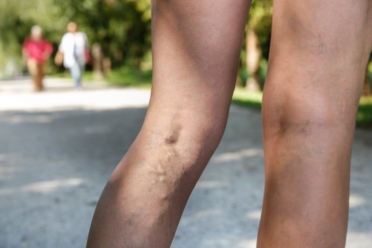 symptoms of Varicose Veins