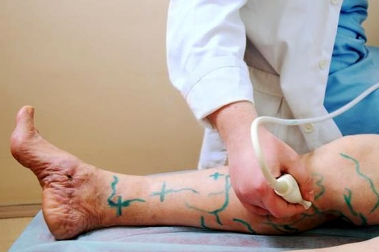 prevent tips for Varicose Veins