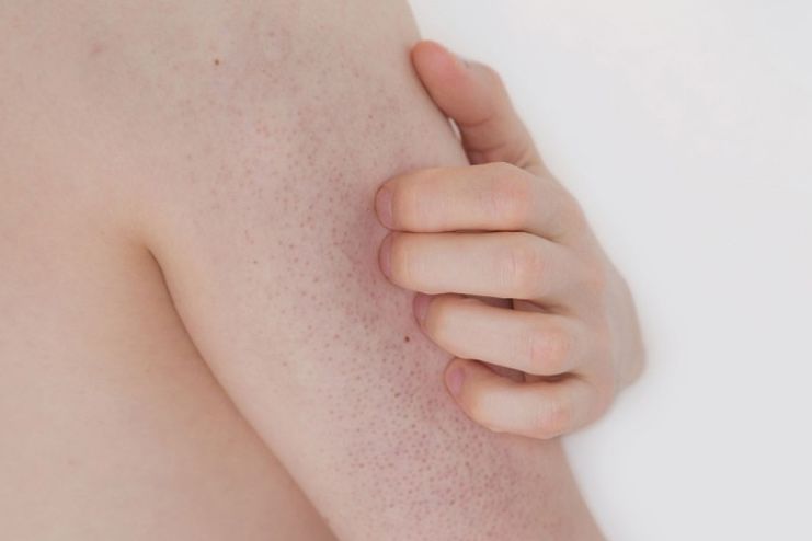 15 Effective Home Remedies For Keratosis Pilaris That Work