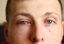 Say Goodbye to Pink Eye: 10 Quick and Effective Home Remedies Pink Eye