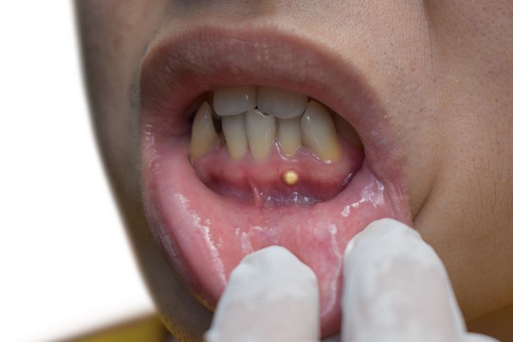 Understanding Abscessed Teeth