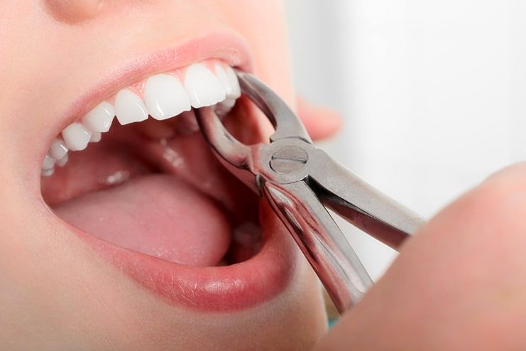 Clove Oil for Dry Socket – Is It Effective?