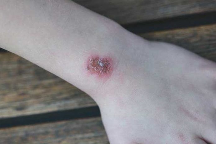 Home Remedies for Staph Infection