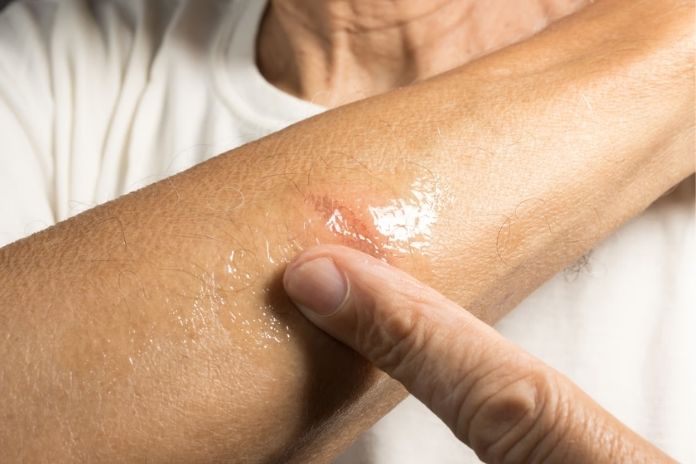 Potato Juice for Wound Healing