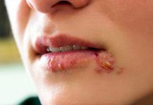 17 Home Remedies For Herpes That Works Wonders Home remedies for herpes