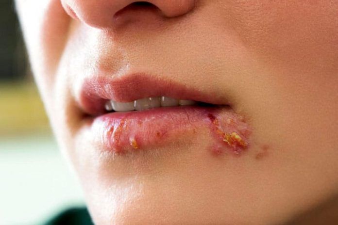 Home remedies for herpes