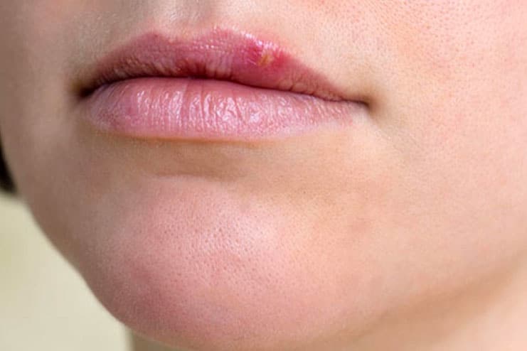 Signs and symptoms of Herpes
