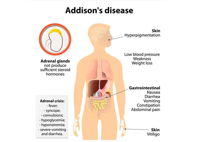 Addison-s Disease