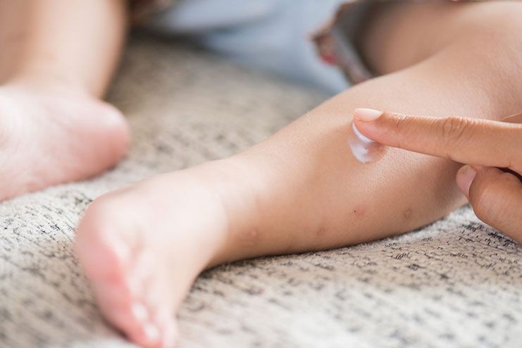 Calamine Lotion for Chickenpox