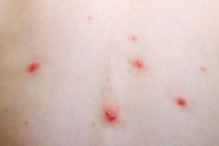 How Does Chickenpox Spread