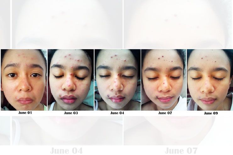 Stages of Chickenpox