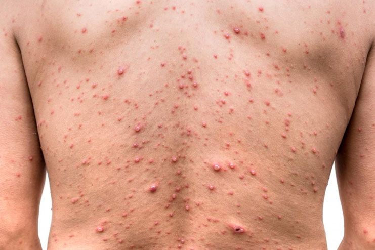 What Are The Signs And Symptoms Of Chickenpox
