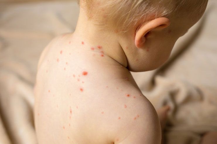 What is Chicken Pox and its causes