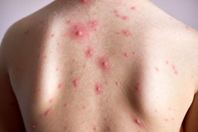 home remedies for chickenpox