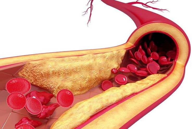 Atherosclerosis