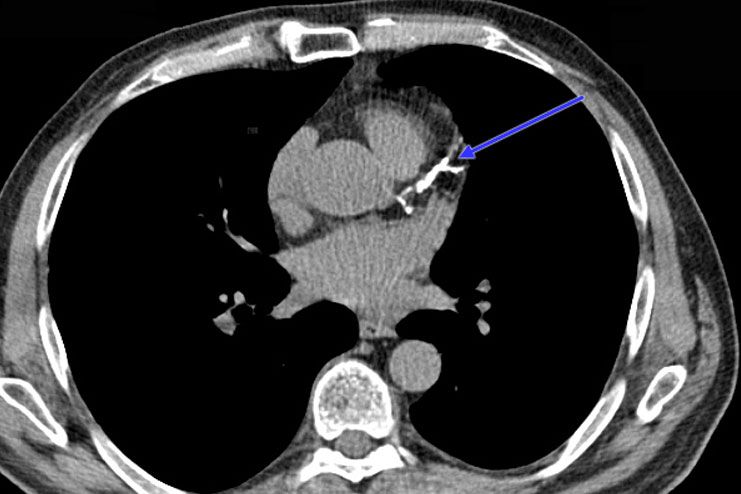 CT-scan