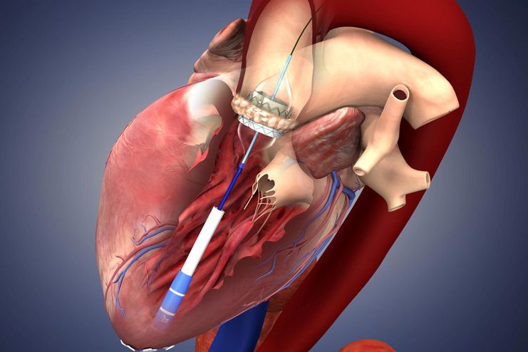 Catheter procedures