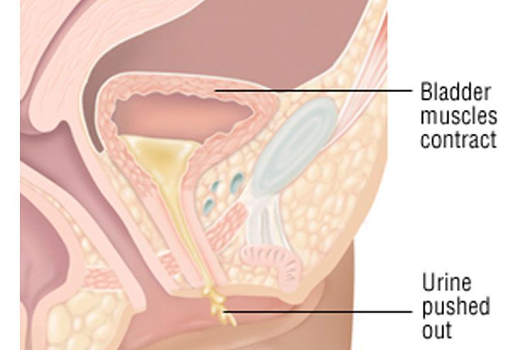 Causes Of Urinary Incontinence