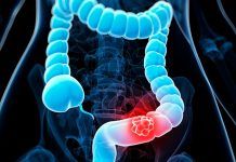 Colon Cancer – Types, Stages, Diagnosis, Treatment And Prevention Colon cancer