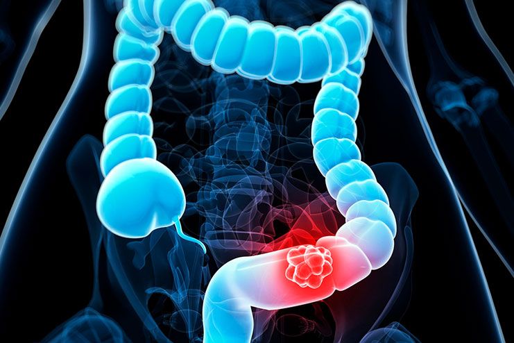 Stages Of Colorectal Cancer