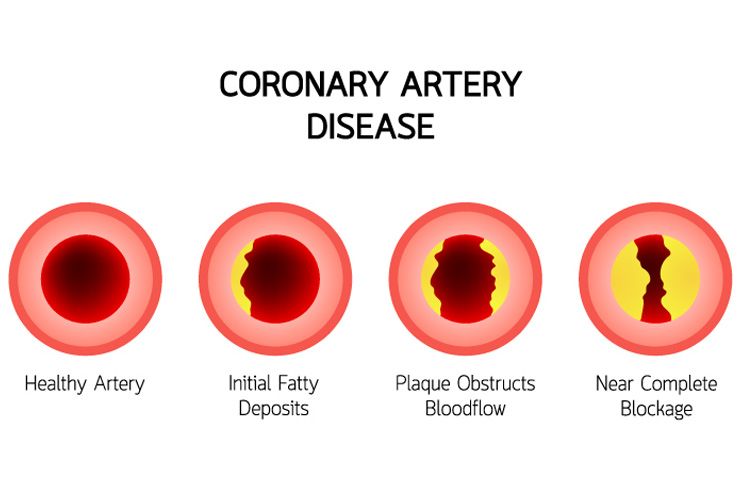 Coronary-artery-disease