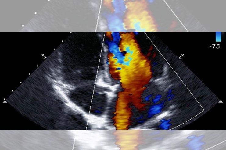 Echocardiogram