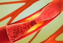 5 Effects Of High Cholesterol You Need To Know Of Effects of high cholesterol